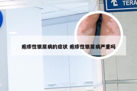 疱疹性银屑病的症状 疱疹性银屑病严重吗