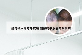 醋花椒水治疗牛皮癣 醋熬花椒水治疗银屑病