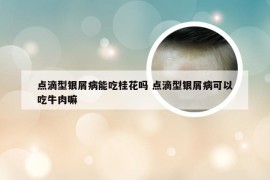 点滴型银屑病能吃桂花吗 点滴型银屑病可以吃牛肉嘛
