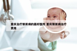 重庆治疗银屑病的最好医院 重庆银屑病治疗费用