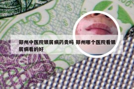 郑州中医院银屑病药贵吗 郑州哪个医院看银屑病看的好