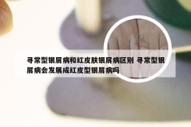 寻常型银屑病和红皮肤银屑病区别 寻常型银屑病会发展成红皮型银屑病吗