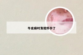 牛皮癣时发现怀孕了