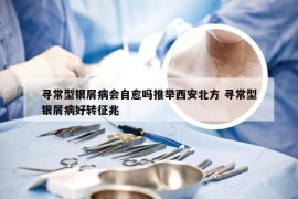 寻常型银屑病会自愈吗推举西安北方 寻常型银屑病好转征兆