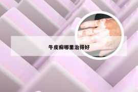 牛皮癣哪里治得好