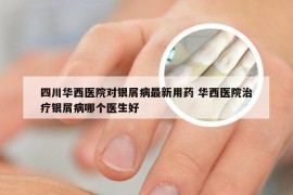 四川华西医院对银屑病最新用药 华西医院治疗银屑病哪个医生好
