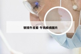 铜钱牛皮廨 牛钱癣病图片