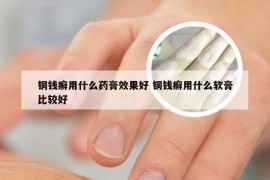 铜钱癣用什么药膏效果好 铜钱癣用什么软膏比较好
