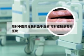 周村中医院皮肤科治牛皮癣 周村皮肤病专科医院