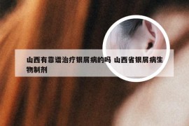 山西有靠谱治疗银屑病的吗 山西省银屑病生物制剂