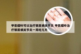 甲氨蝶呤可以治疗银屑病关节炎 甲氨蝶呤治疗银屑病关节炎一周吃几片