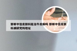 邯郸中信皮肤科能治牛皮癣吗 邯郸中信皮肤科病研究所地址
