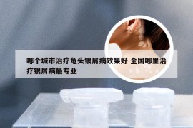 哪个城市治疗龟头银屑病效果好 全国哪里治疗银屑病最专业