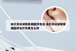 哈尔滨冰城银屑病医院电话 哈尔滨冰城银屑病医院治疗效果怎么样