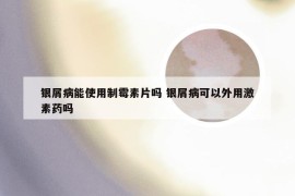 银屑病能使用制霉素片吗 银屑病可以外用激素药吗