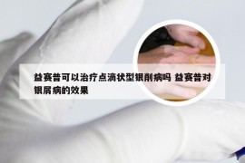 益赛普可以治疗点滴状型银削病吗 益赛普对银屑病的效果