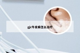 gjc牛皮癣怎么治疗