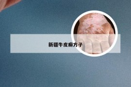 新疆牛皮癣方子