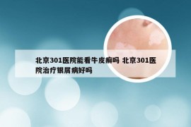 北京301医院能看牛皮癣吗 北京301医院治疗银屑病好吗