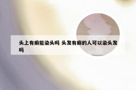 头上有癣能染头吗 头发有癣的人可以染头发吗