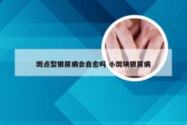 斑点型银屑病会自愈吗 小斑块银屑病
