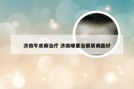 济南牛皮癣治疗 济南哪里治银屑病最好