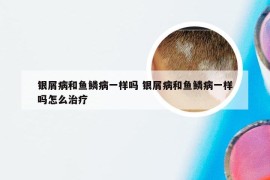 银屑病和鱼鳞病一样吗 银屑病和鱼鳞病一样吗怎么治疗