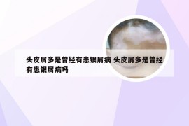 头皮屑多是曾经有患银屑病 头皮屑多是曾经有患银屑病吗
