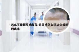 怎么不让银屑病复发 银屑病怎么阻止它长新的出来
