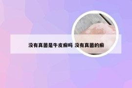 没有真菌是牛皮癣吗 没有真菌的癣