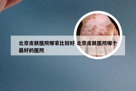 北京皮肤医院哪家比较好 北京皮肤医院哪个最好的医院