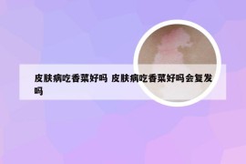 皮肤病吃香菜好吗 皮肤病吃香菜好吗会复发吗