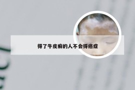 得了牛皮癣的人不会得癌症