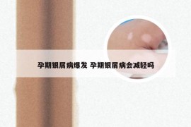 孕期银屑病爆发 孕期银屑病会减轻吗