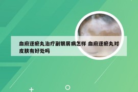 血府逐瘀丸治疗副银屑病怎样 血府逐瘀丸对皮肤有好处吗