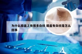 为什么膝盖上有很多白纹 膝盖有白纹是怎么回事