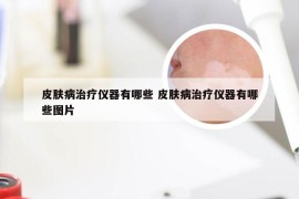 皮肤病治疗仪器有哪些 皮肤病治疗仪器有哪些图片