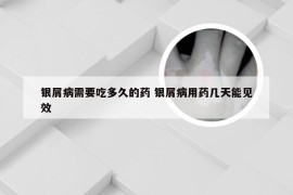 银屑病需要吃多久的药 银屑病用药几天能见效