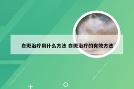 白斑治疗用什么方法 白斑治疗的有效方法