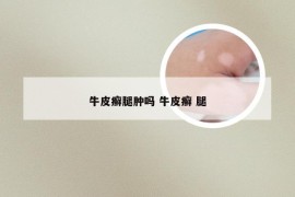牛皮癣腿肿吗 牛皮癣 腿