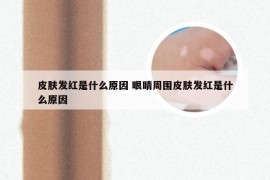 皮肤发红是什么原因 眼睛周围皮肤发红是什么原因