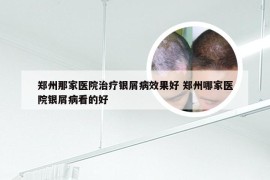 郑州那家医院治疗银屑病效果好 郑州哪家医院银屑病看的好