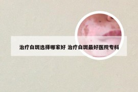 治疗白斑选择哪家好 治疗白斑最好医院专科