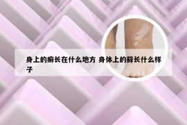 身上的癣长在什么地方 身体上的藓长什么样子