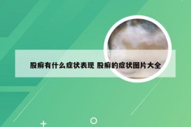 股癣有什么症状表现 股癣的症状图片大全