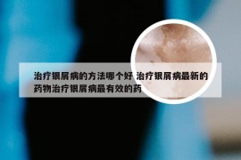 治疗银屑病的方法哪个好 治疗银屑病最新的药物治疗银屑病最有效的药