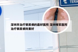 深圳市治疗银屑病的最好医院 深圳哪家医院治疗银屑病效果好
