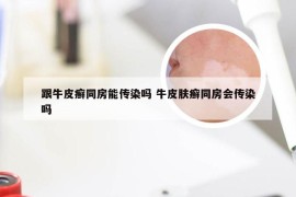 跟牛皮癣同房能传染吗 牛皮肤癣同房会传染吗