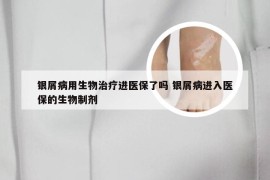 银屑病用生物治疗进医保了吗 银屑病进入医保的生物制剂