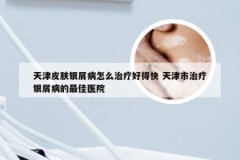 天津皮肤银屑病怎么治疗好得快 天津市治疗银屑病的最佳医院